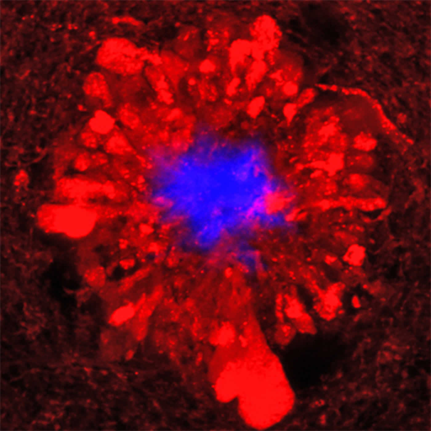 Image shows amyloid plaques and damaged neurons.