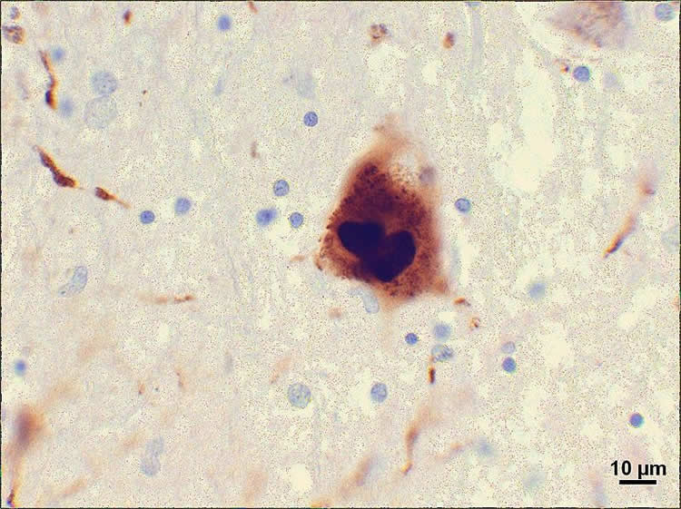 Image shows Lewy bodies in the substantia nigra.