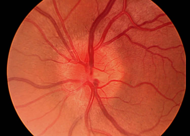 Image shows optic neuritis.
