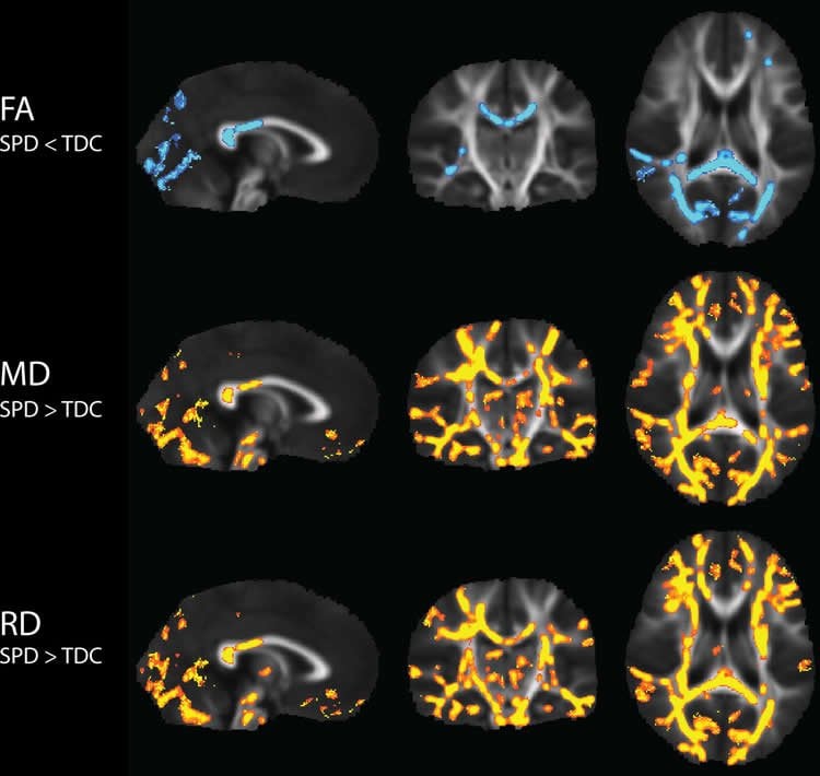 Image shows brain scans from the research.
