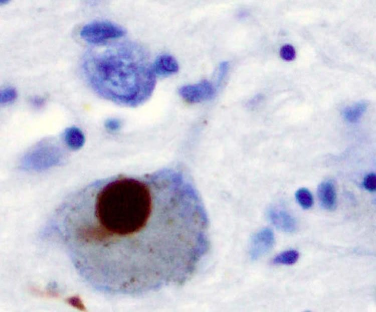 Image shows positive α-Synuclein staining of a Lewy body in a patient with Parkinson's disease.