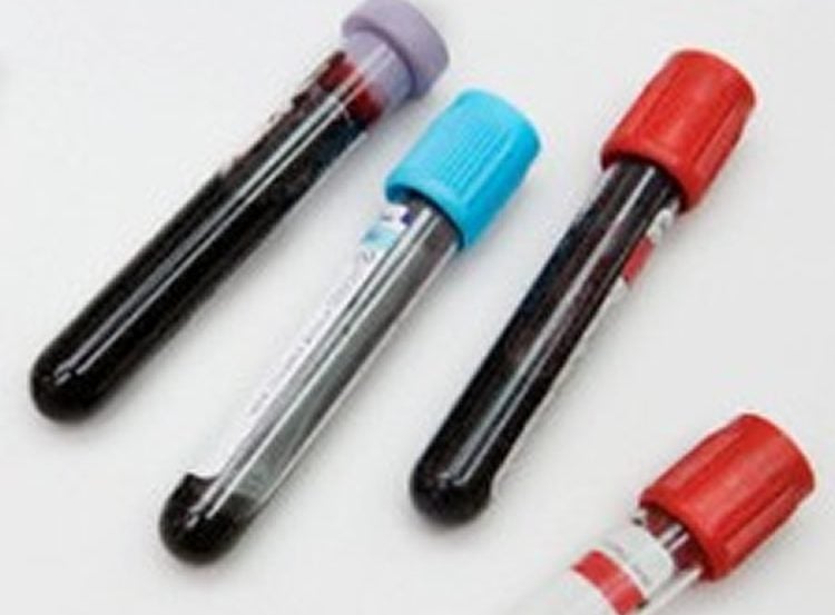 Image shows a blood in tubes.