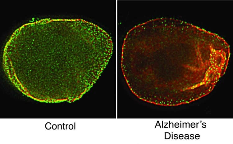 Image shows a cell nucleus from a health and alzheimer's brain.
