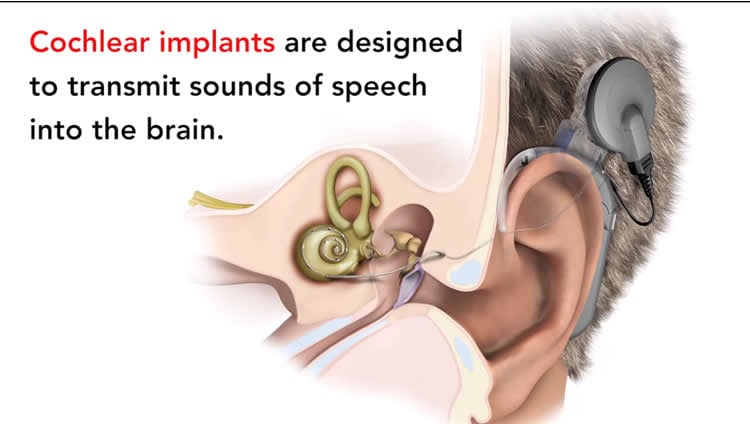 Labelled diagram of a cochlear implant.