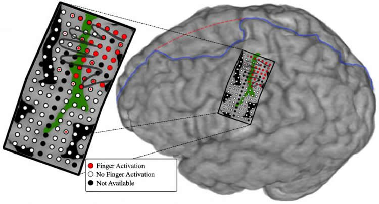 Illustration showing the electrode array on the subject's brain.