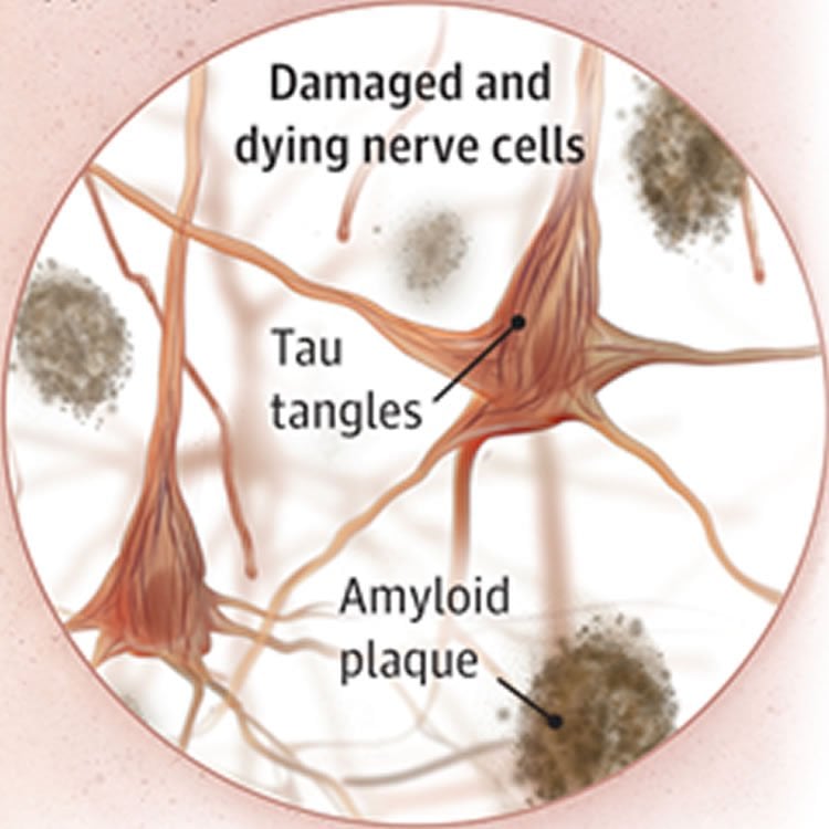 Image shows neurons with tau tangles.