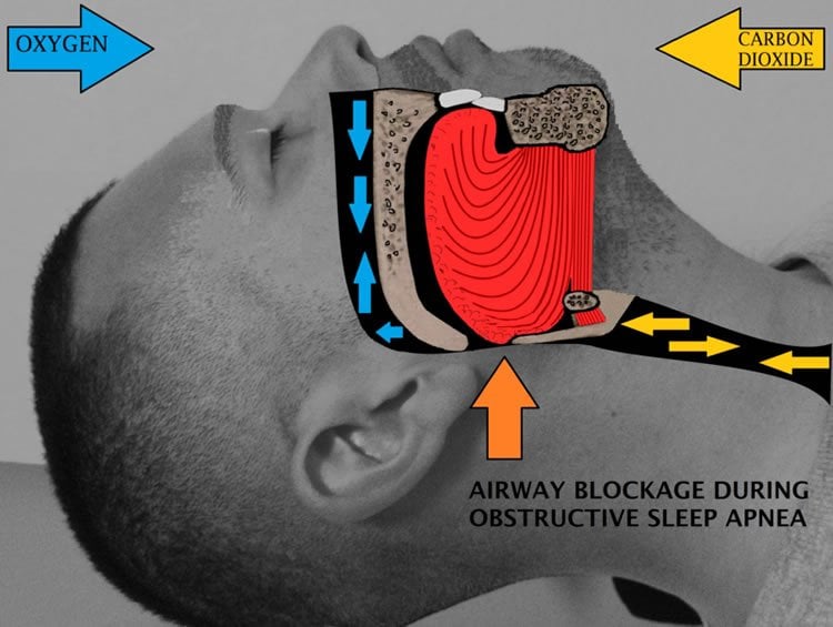 Image shows obstructive airway in a sleep apnea patient.