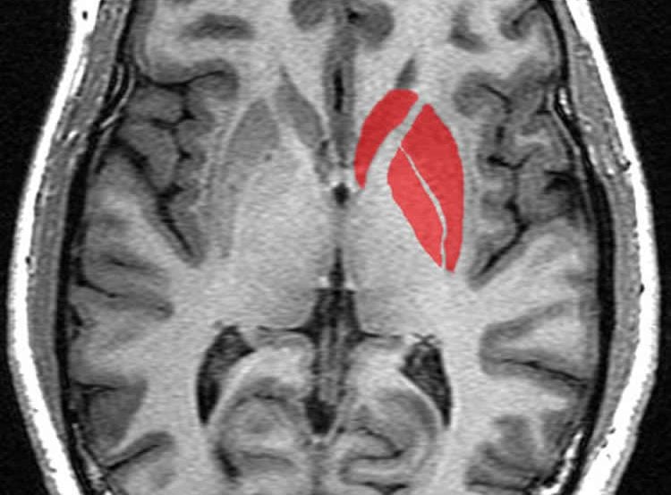 Brain scan with the striatum highlighted in red.