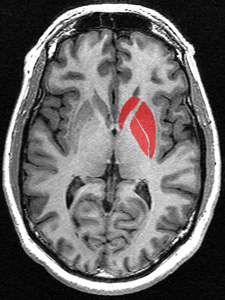 Brain scan with the striatum highlighted in red.
