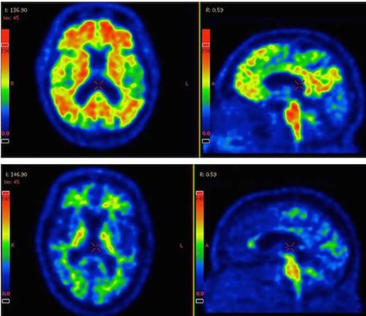 PET scans show AB spots in the brain of an Alzheimer's patient.