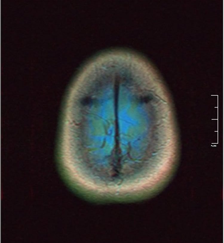Image shows brain scan of glioma.
