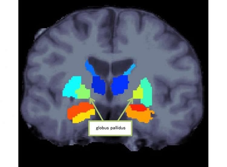 Image shows a brain scan with the globus pallidus highlighted.
