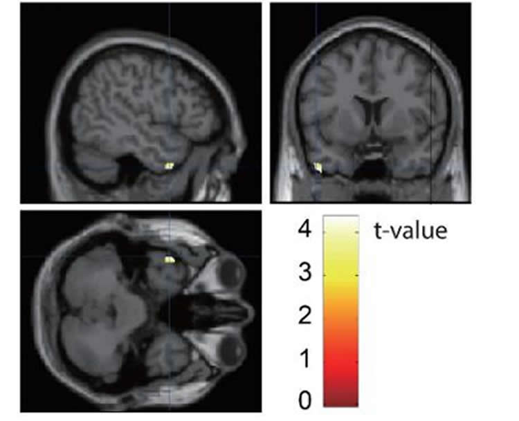 Image of brain scans with the middle temporal gyrus highlighted.
