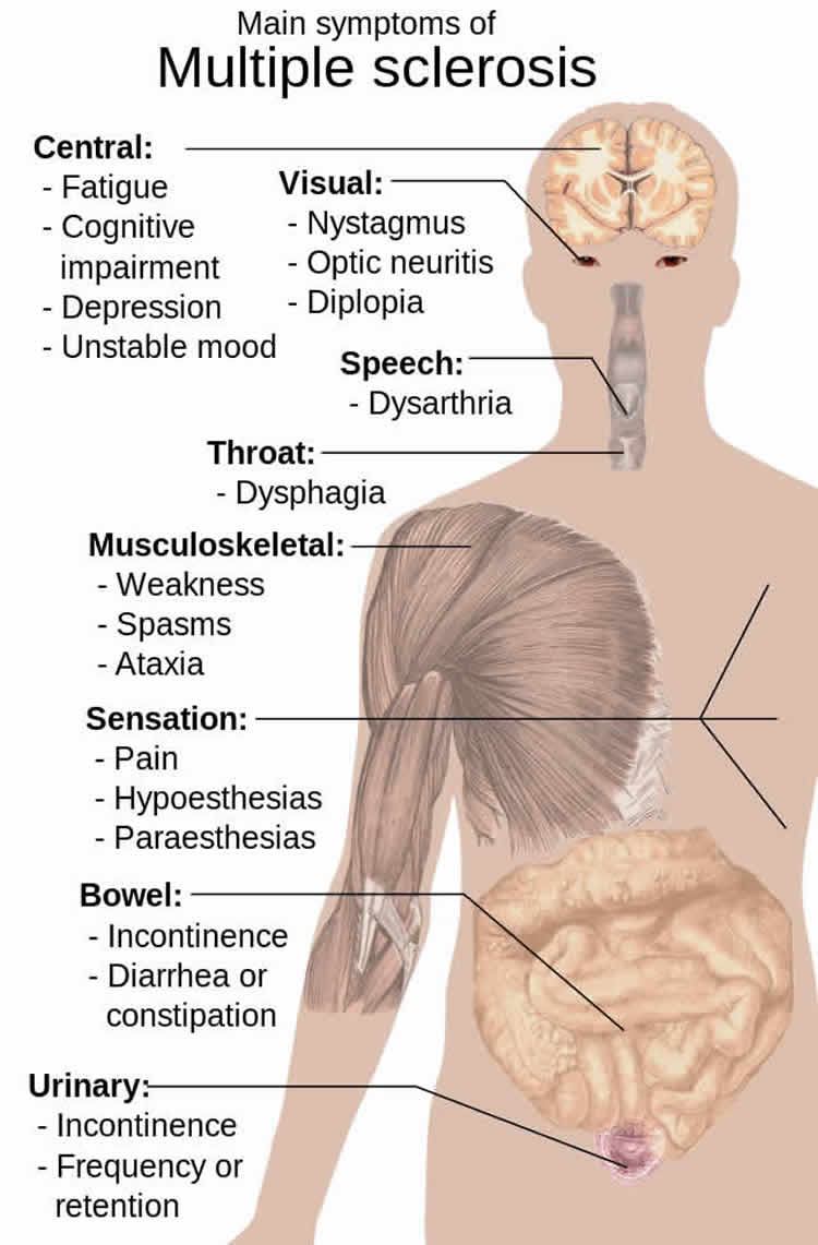 Diagram shows how MS affects the body.