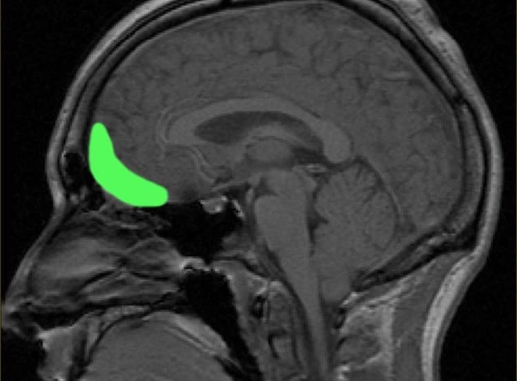 Location of the OFC is highlighted green in this brain scan.