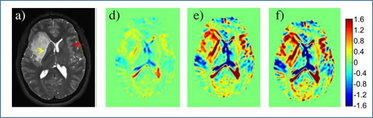 Image shows MRI scans from the study.