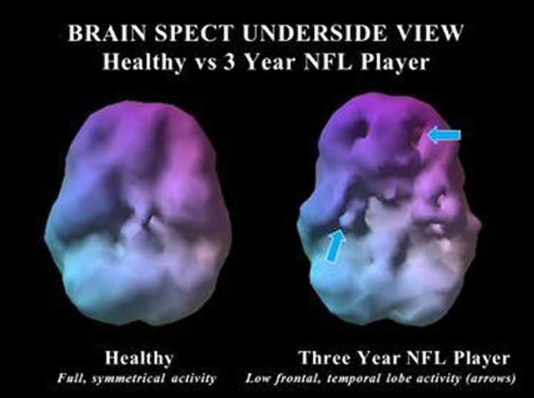 Image shows brain scans from the study. The caption best describes the image.