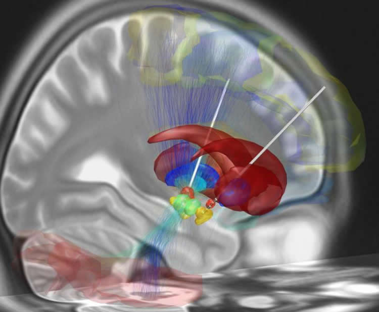 Image shows a brain scan with the electrodes from the DBS showing.
