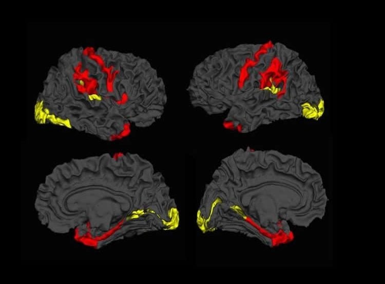 Image shows brain scans with the cortical thickness higlighted in red and yellow.