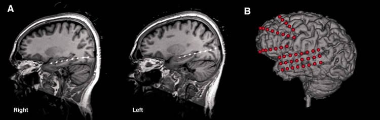 Image shows brain scans with the electrodes implanted.