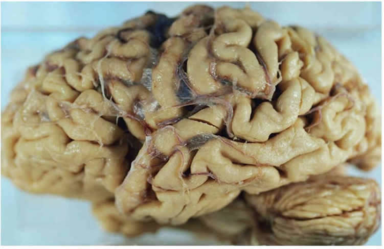 Image shows a brain of an alzheimer's patient.