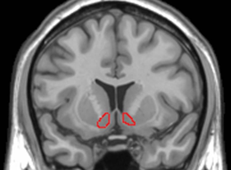 Image shows the location of the NAc in the human brain.