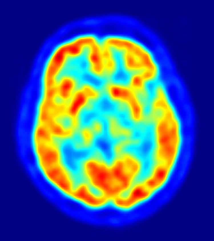 pet-imaging-with-special-tracer-can-detect-and-diagnose-early-alzheimer