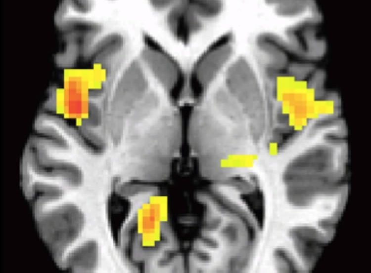 Image shows the left and right insula highlighed in a brain scan.