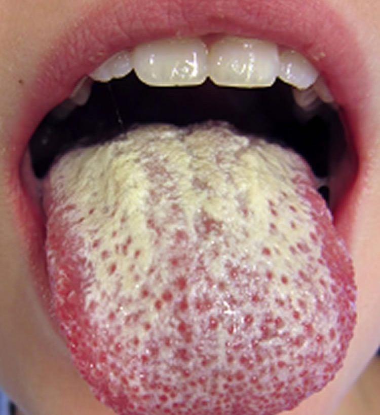 Photo of a person with an oral Candida infection.