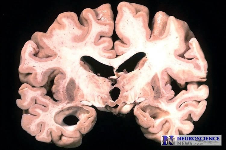Image shows a brain slice from an Alzheimer's patient.
