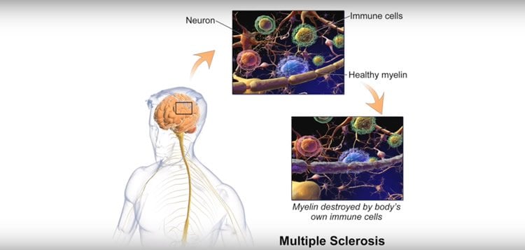 Image shows how myelin is affected in MS.