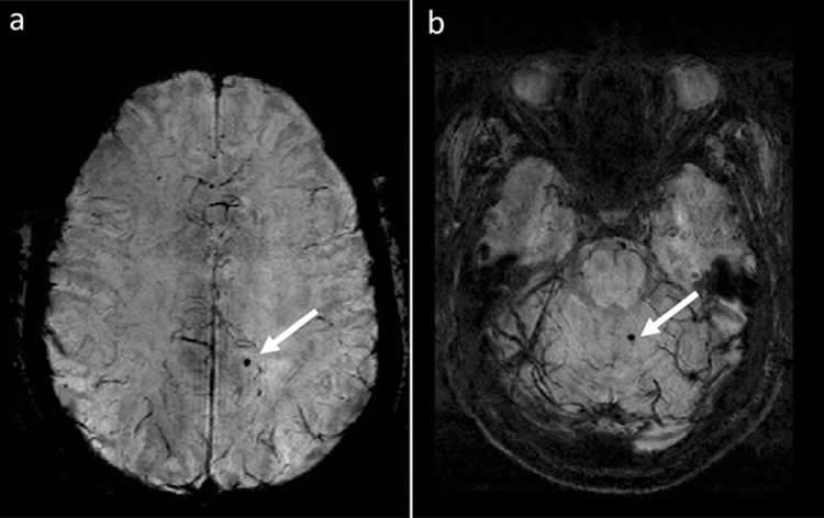 Image shows a microbleed in a brain scan.