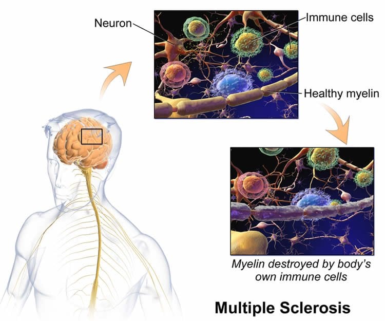 Image shows how myelin is lost in ms.