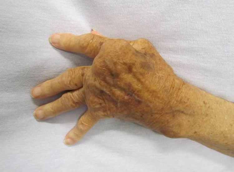 Photo of hand of a person with RA.