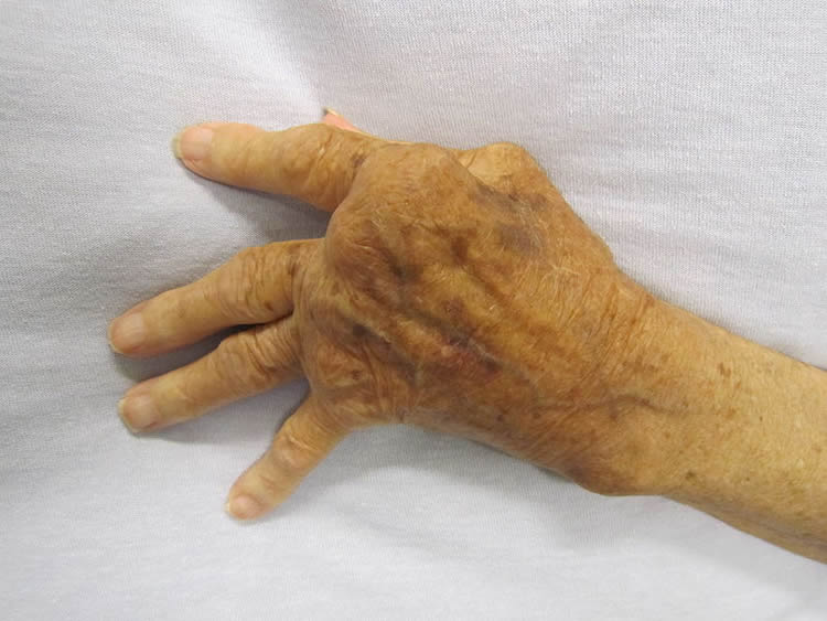 Photo of hand of a person with RA.