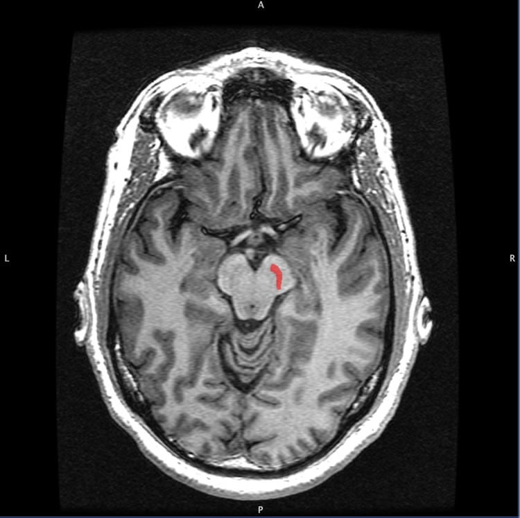 Image shows the location of the substantia nigra in the brain.