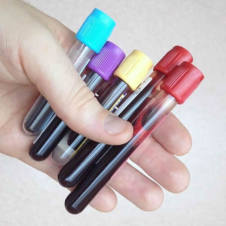 Image shows vials of blood.