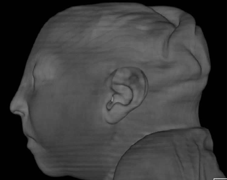 Image shows ct reconstruction of a baby's head.