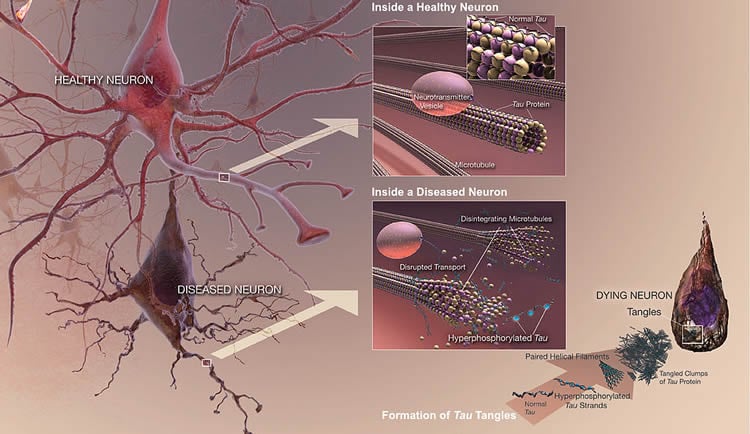 Image shows how tau affects the brain.