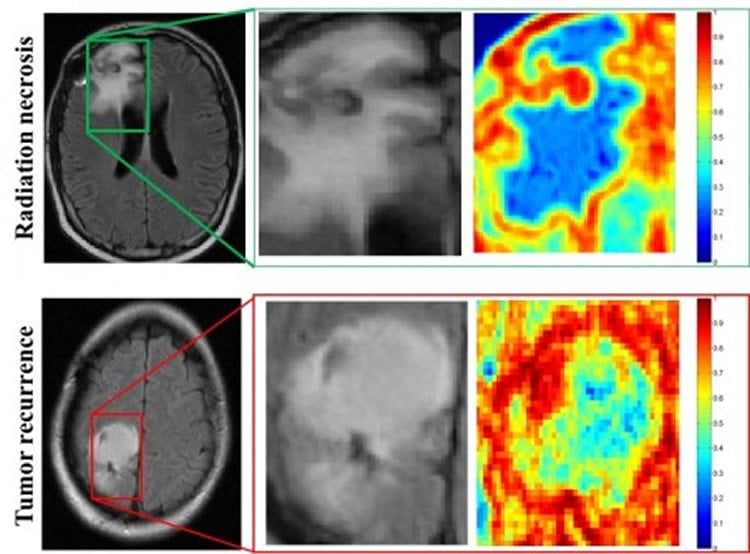 Image shows brain cancer scans.