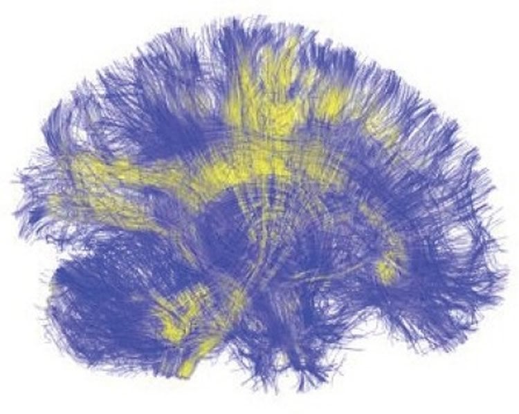 Image shows white matter in the brain.