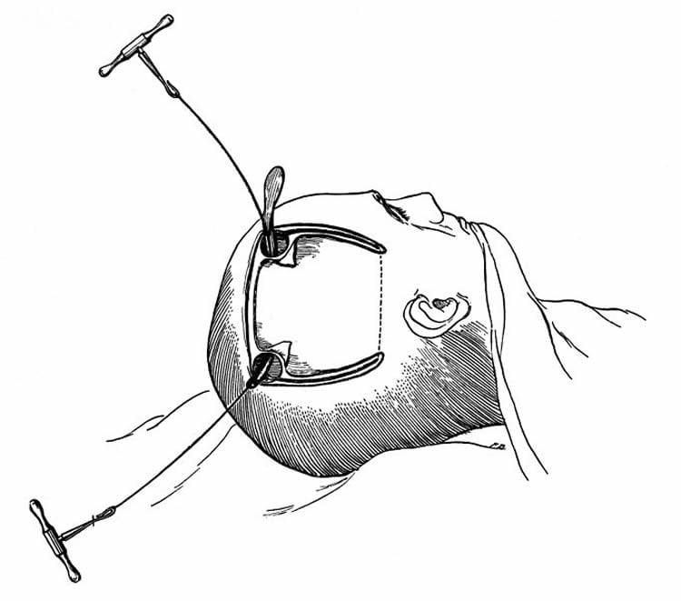Image shows a craniectomy.