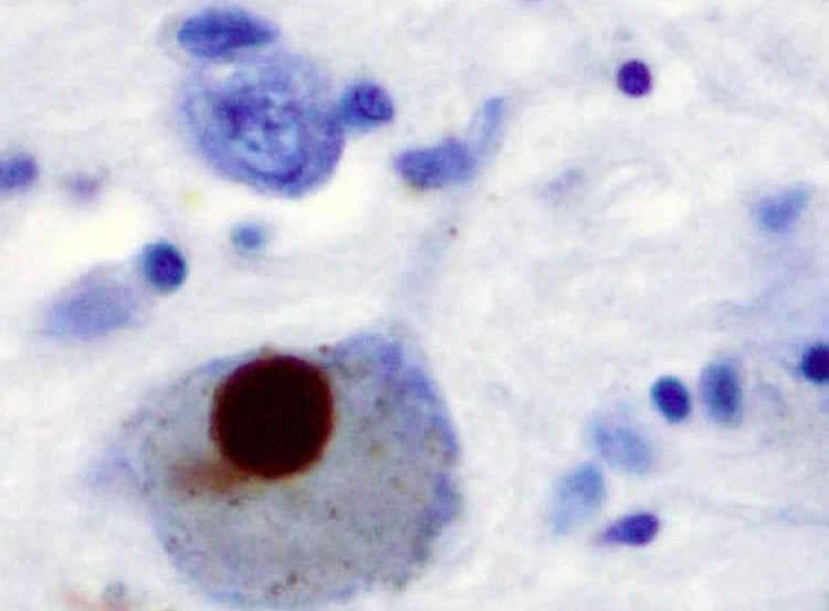 Image shows stained brain slice for alpha synuclein.