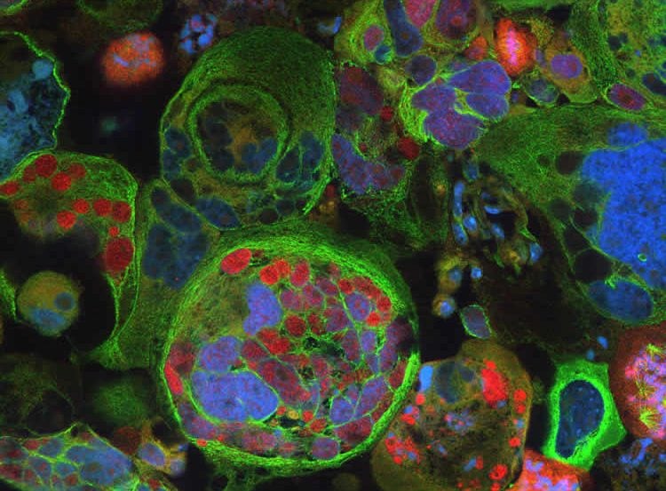 Image shows glioblastoma tumor cells.
