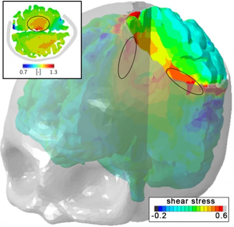Image shows an MRI brain scan.