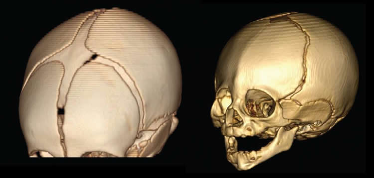 Image shows a 3d representation of a baby's skull.