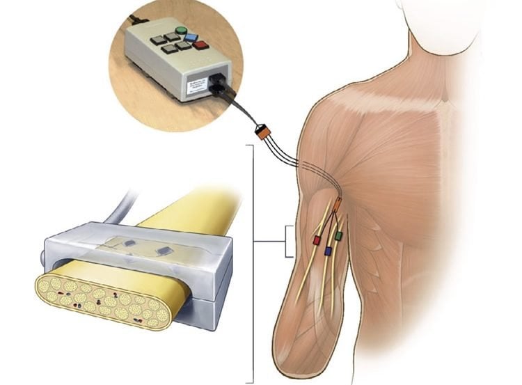 Image shows a how the electrodes were implanted into the arm stump.