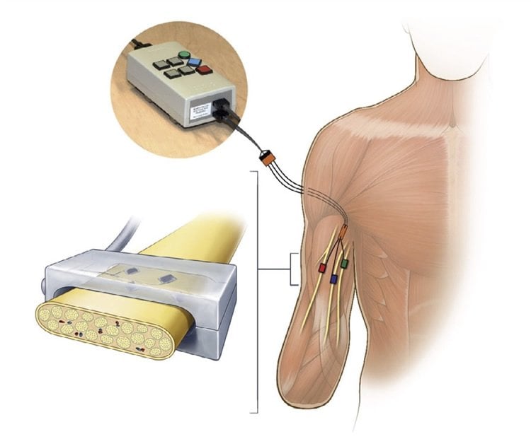 Image shows a how the electrodes were implanted into the arm stump.