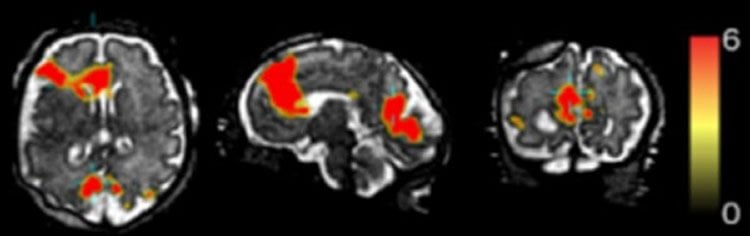 Image shows an MRI of a fetal brain.