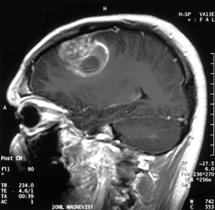 Image shows an MRI brain scan of a glioblastoma patient.